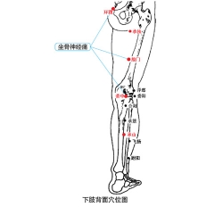 坐骨神经痛理疗仪