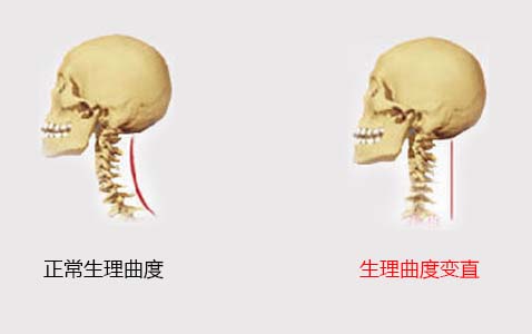 正常曲度和变直曲度