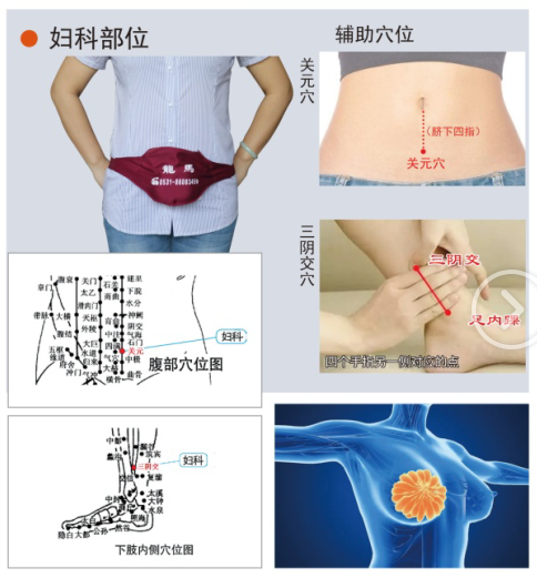 盆腔炎治疗仪